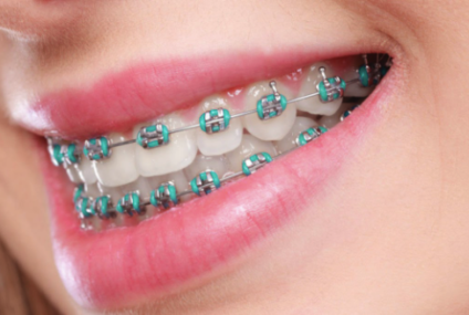 Igiena buco-dentara atunci cand porti un aparat ortodontic