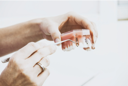 De ce implantul dentar este cea mai bună opțiune pentru înlocuirea unui dinte lipsă?