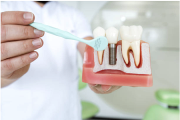 Ce trebuie să știi despre contraindicațiile implantului dentar?